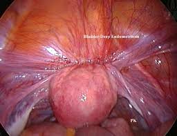 endometriosis grade 43